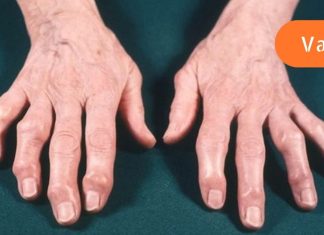 მედიცინის ფასდაუდებელი რეკომენდაციები ართრიტისა და ართროზის დროს!