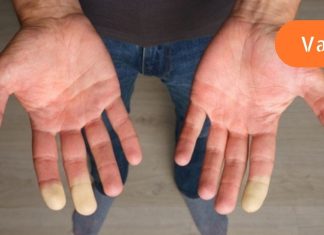 როგორ გავაუმჯობესოთ სისხლის მიმოქცევა წამლების გარეშე