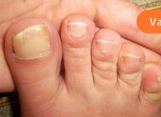 მე ფრჩხილის სოკო ჩვეულებრივი კვერცხისა და ძმრის საშუალებით მოვირჩინე.. აი რა გავაკეთე..