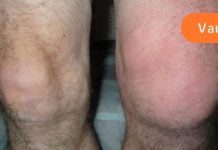 რას ნიშნავს სითხის დაგროვება სახსარში? როგორ უნდა ვუმკურნალოთ მას? გაიგეთ მეტი სახსრებში სითხის დაგროვების სიმპტომებსა და მკურნალობაზე..