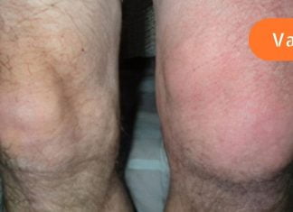 რას ნიშნავს სითხის დაგროვება სახსარში? როგორ უნდა ვუმკურნალოთ მას? გაიგეთ მეტი სახსრებში სითხის დაგროვების სიმპტომებსა და მკურნალობაზე..