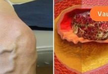 ფაფა, რომელიც ხსნის თრომბებს – ეს ნამდვილად ხსნაა გადიდებული და ანთებული ვენებისთვის