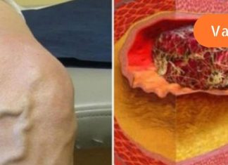 ფაფა, რომელიც ხსნის თრომბებს – ეს ნამდვილად ხსნაა გადიდებული და ანთებული ვენებისთვის