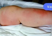 რა არის თრომბი და როგორ შეგვიძლია მისი თავიდან აცილება? ამ სტატიას ბევრი ადამიანის სიცოცხლის გადარჩენა შეუძლია!.