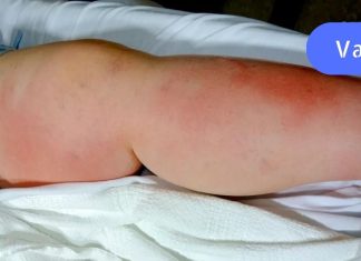 რა არის თრომბი და როგორ შეგვიძლია მისი თავიდან აცილება? ამ სტატიას ბევრი ადამიანის სიცოცხლის გადარჩენა შეუძლია!.