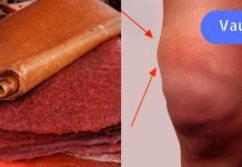 აი როგორ უნდა გამოვიყენოთ ტყემლის ტყლაპი სახსარში დაგროვებული სითხის გამოსადევნად