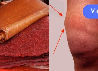 აი როგორ უნდა გამოვიყენოთ ტყემლის ტყლაპი სახსარში დაგროვებული სითხის გამოსადევნად