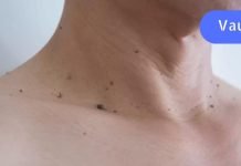 სხეულზე მქონდა უამრავი ვირუსული მეჭეჭი.. დედაჩემმა მასწავლა ხალხური რეცეპტი, რომლის მეშვეობითაც მე მთლიანად მოვიშორე ისინი..