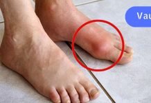 დედაჩემს აწუხებდა ფეხის დიდ თითზე მარილების დაგროვება.. მან ამ ხერხს მიმართა და დაისვენა..