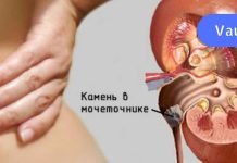 როგორ შევაჩეროთ თირკმლის ქვების წარმოქმნა? ამ სტატიაში ჩვენ გთავაზობთ რამდენიმე სასარგებლო რჩევას.