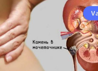 როგორ შევაჩეროთ თირკმლის ქვების წარმოქმნა? ამ სტატიაში ჩვენ გთავაზობთ რამდენიმე სასარგებლო რჩევას.