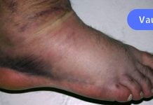 ფეხების და სახსრების შეშუპება: მიზეზები და მკურნალობა