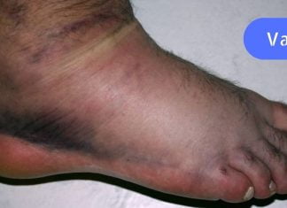 ფეხების და სახსრების შეშუპება: მიზეზები და მკურნალობა