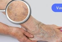 ვარიკოზული ვენები აიურვედას თვალსაზრისით. ყველაზე ეფექტური მკურნალობა