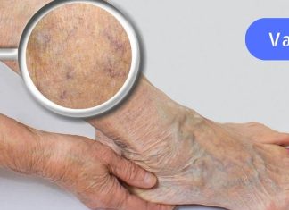 ვარიკოზული ვენები აიურვედას თვალსაზრისით. ყველაზე ეფექტური მკურნალობა