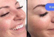 მოიშორეთ ასაკობრივი ლაქები, ნაოჭები, ცხიმიანი ბზინვარება და შავი წერტილები 1 კვირაში