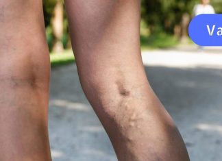 თუ თრომბის სიმპტომები გაქვს, სასწრაფოდ უნდა დაიწყო ამ ფაფის მიღება. ის ხსნის თრომბს..