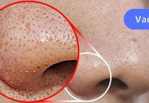 შავი წერტილების მოსაშორებლად გამოიყენეთ ეს საოცარი ნიღაბი.. ამაზე ეფექტური ჯერ არაფრი შემხვედრია..