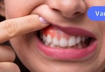 გამოიყენეთ ბებიას საშინაო საშუალებები ღრძილების ანთების დროს.. ეფექტურია..