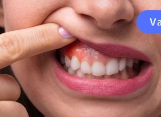 გამოიყენეთ ბებიას საშინაო საშუალებები ღრძილების ანთების დროს.. ეფექტურია..