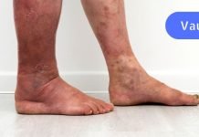 ჩაკეთილი თრომბის დროს, გირჩევთ გამოიყემოთ ეს ფასდაუდებელი რეცეპტი.. ის ერთხელ და სამუდამოდ მოგაშორებთ ამ დაავადებას..