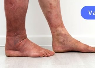 ჩაკეთილი თრომბის დროს, გირჩევთ გამოიყემოთ ეს ფასდაუდებელი რეცეპტი.. ის ერთხელ და სამუდამოდ მოგაშორებთ ამ დაავადებას..