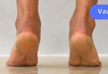 კურკუმა, ასპირინი და სპირტი: გამოიყენეთ ეს კომბინაცია დაბზარული ქუსლების სამკურნალოდ!