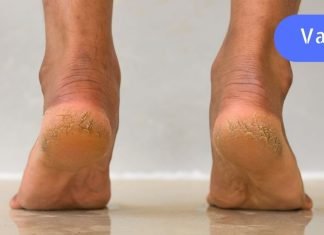 კურკუმა, ასპირინი და სპირტი: გამოიყენეთ ეს კომბინაცია დაბზარული ქუსლების სამკურნალოდ!