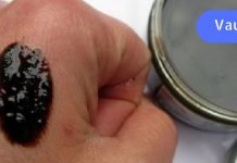 ფსორიაზის და ეფზემის დროს გირჩევთ გამოიყენოთ ეს ხალხური რეცეპტი. ის სწრაფად და მარტივად მოგირჩენთ ამ აავადებებს.. ძალიან ეფექტურია..