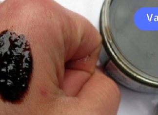 ფსორიაზის და ეფზემის დროს გირჩევთ გამოიყენოთ ეს ხალხური რეცეპტი. ის სწრაფად და მარტივად მოგირჩენთ ამ აავადებებს.. ძალიან ეფექტურია..