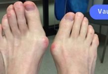 აი როგორ მოვიშორე ძვლოვანი წანაზარდი ფეხის დიდ თითზე… რეცეპტი ბევრს გამოადგება..