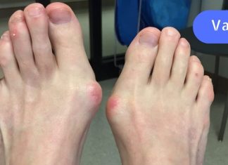 აი როგორ მოვიშორე ძვლოვანი წანაზარდი ფეხის დიდ თითზე… რეცეპტი ბევრს გამოადგება..