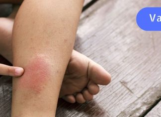 სისხლის შედედება (თრომბი): სიმპტომები, რომლებსაც შეუძლიათ თქვენი სიცოცხლის გადარჩენა