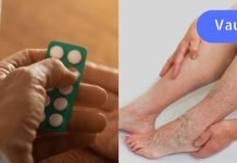 ასპირინის თერაპიული ხსნარი ვარიკოზული ვენებისა და ოსტეოქონდროზის დროს