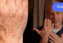 ორკომპონენტიანი საშინაო საშუალება კანზე ყავისფერი ლაქების სამკურნალოდ