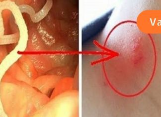 როგორ მოვიშოროთ პარაზიტები: ყველაზე ეფექტური საშუალებები ორგანიზმიდან ჭიების მოსაშორებლად..