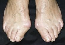 როგორ ვუმკურნალოთ ბუნიონს ყოველგვარი ქიმიკატების გარეშე? ამაში ეს ინგრედიენტები დაგეხმარებათ!