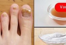 ფეხის სოკოს სამკურნალო ბუნებრივი საშუალება!. რეცეპტი, რომელმაც უამრავი ადამიანი გააბედნიერა..