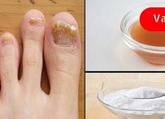 ფეხის სოკოს სამკურნალო ბუნებრივი საშუალება!. რეცეპტი, რომელმაც უამრავი ადამიანი გააბედნიერა..
