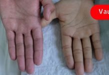 ანემიის 13 ნიშანი: როგორ გავიგოთ, რომ მეტი რკინა გვჭირდება