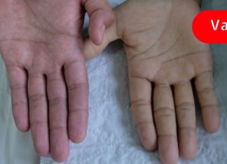 ანემიის 13 ნიშანი: როგორ გავიგოთ, რომ მეტი რკინა გვჭირდება