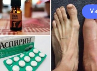 იოდი და ასპირინი: კომბინაცია, რომლის დახმარებითაც ბურსიტი 1 კვირაში მოვიშორე..
