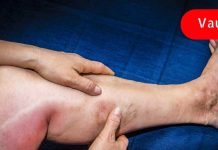 სისხლის შედედების 7 ადრეული გამაფრთხილებელი სიმპტომი, რომელიც არ უნდა უგულებელყოთ! შენ უნდა იცოდე!