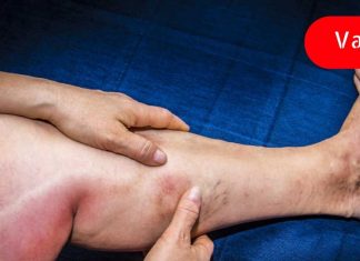 სისხლის შედედების 7 ადრეული გამაფრთხილებელი სიმპტომი, რომელიც არ უნდა უგულებელყოთ! შენ უნდა იცოდე!