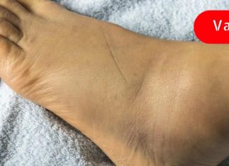 მეცნიერები განმარტავენ 6 ფაქტორს, რაც იწვევს ფეხების შეშუპებას! Შენ უნდა იცოდე!