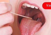 როგორ მოვიშოროთ შეშუპებული ყელი ერთ დღეში ყოველგვარი მედიკამენტების გარეშე? ეს მნიშვნელოვანია!