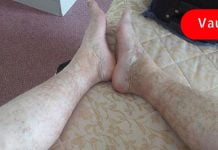 გააუმჯობესეთ სისხლის ცუდი მიმოქცევა რამდენიმე სასარგებლო ბუნებრივი მეთოდით, რომლებიც შეიძლება სასარგებლო იყოს.