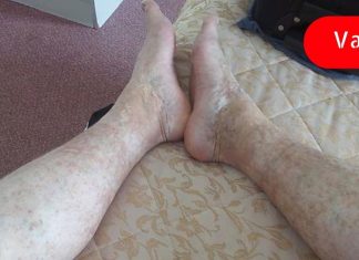 გააუმჯობესეთ სისხლის ცუდი მიმოქცევა რამდენიმე სასარგებლო ბუნებრივი მეთოდით, რომლებიც შეიძლება სასარგებლო იყოს.