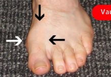 თუ ბურსიტის აუტანელი ტკივილი გაწუხებს, მაშინ ეს სტატია უნდა წაიკითხო..