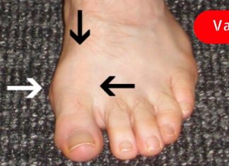 თუ ბურსიტის აუტანელი ტკივილი გაწუხებს, მაშინ ეს სტატია უნდა წაიკითხო..